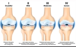 Stem Cell Treatment for Osteoarthritis Provides Pain Relief