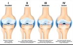 Stem Cell Treatment for Osteoarthritis Provides Pain Relief