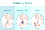 The Difference Between Arthritis and Bursitis