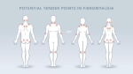 The History of Fibromyalgia