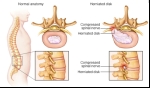 Tips for Lumbar Herniated Disc Pain Relief