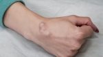 Understanding Ganglion Cysts