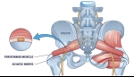 Piriformis Syndrome and Its Management Through Interventional Pain Techniques
