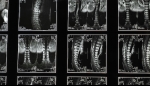 Scoliosis and Its Management