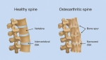 Spinal Arthritis and How Interventional Pain Management Can Help