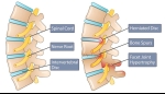 Spinal Stenosis: A Comprehensive Overview