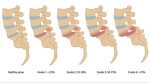 Spondylolisthesis and its Treatment with Interventional Pain Management
