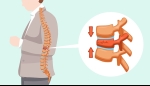 Vertebral Compression Fractures