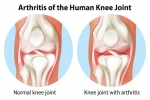 Viscosupplementation Treatment for Knee Arthritis