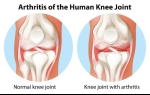 Viscosupplementation Treatment for Knee Arthritis