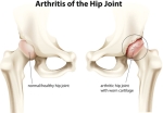 What Are the Treatment Options for Hip Arthritis?