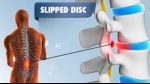 What is a Slipped Disc?