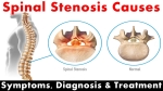 What Is Spinal Stenosis?