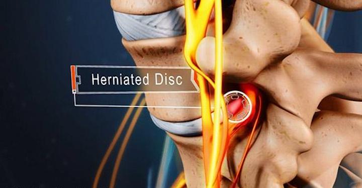 Is a Heating Pad Good for a Herniated Disc?